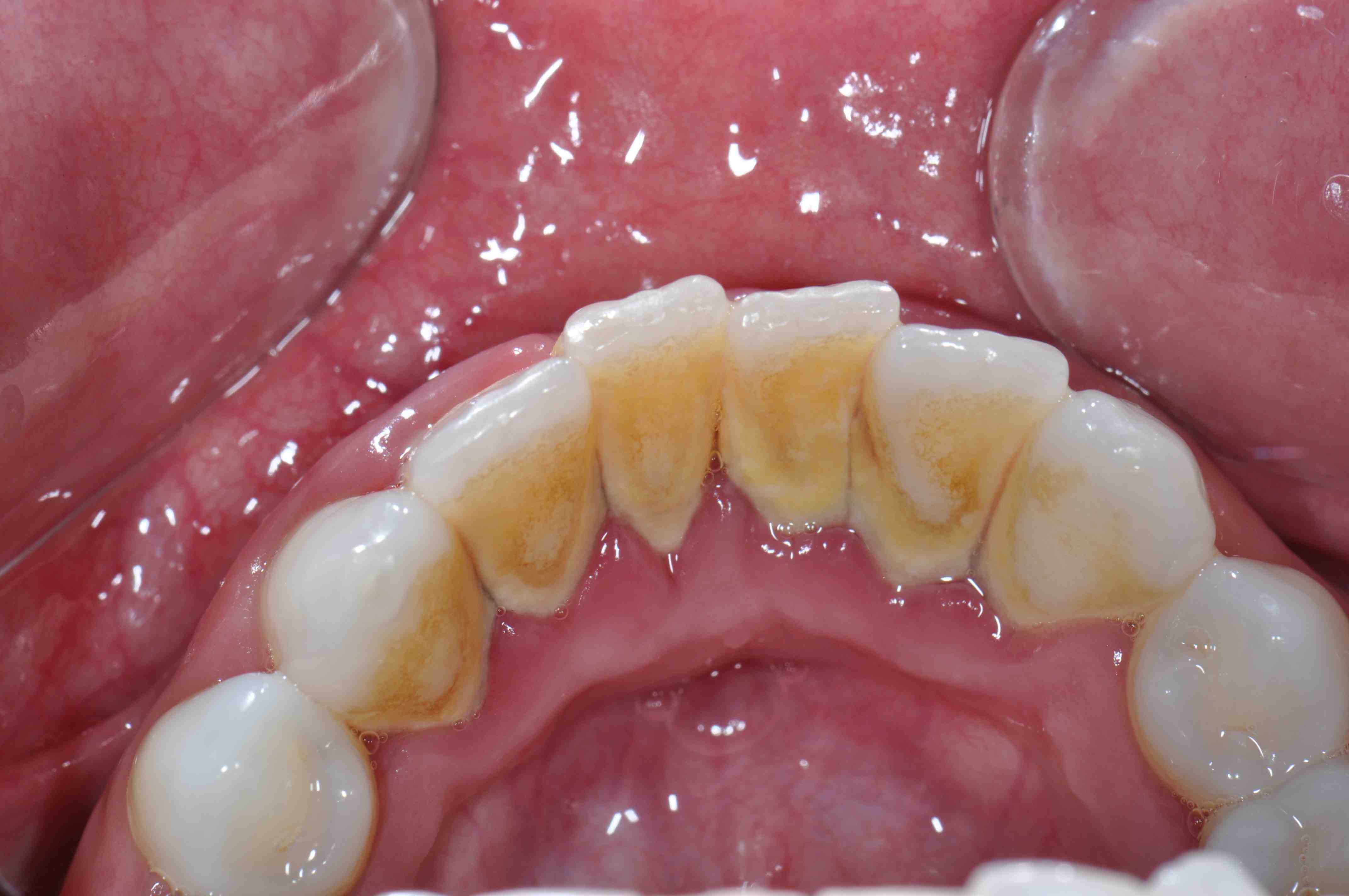 dental-calculus-meddic