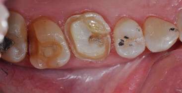 Immediate Dentin Sealing - Lee Ann Brady DMD