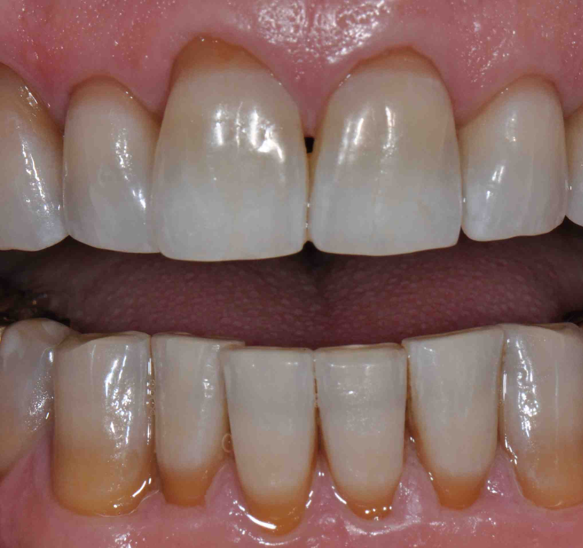 tetracycline teeth baby