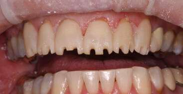 Anterior Teeth with Incisal Depth Cuts into Mock Up