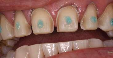 Cementing Veneer Provisionals - Lee Ann Brady DMD