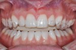 Anterior Bite Plane