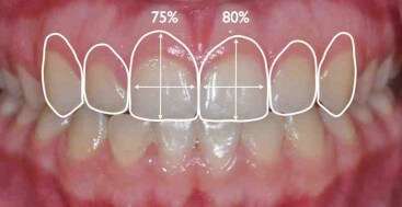 gingival margin