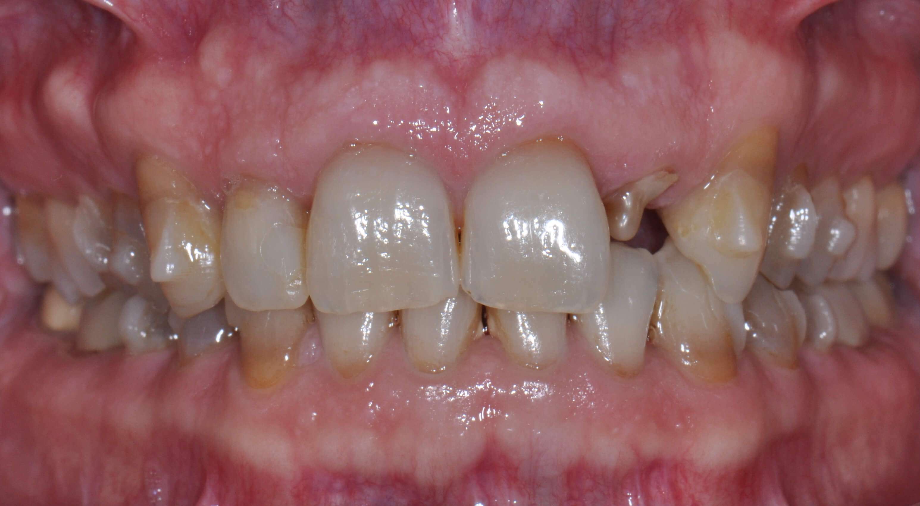 Placing Invisalign Attachments - Lee Ann Brady DMD