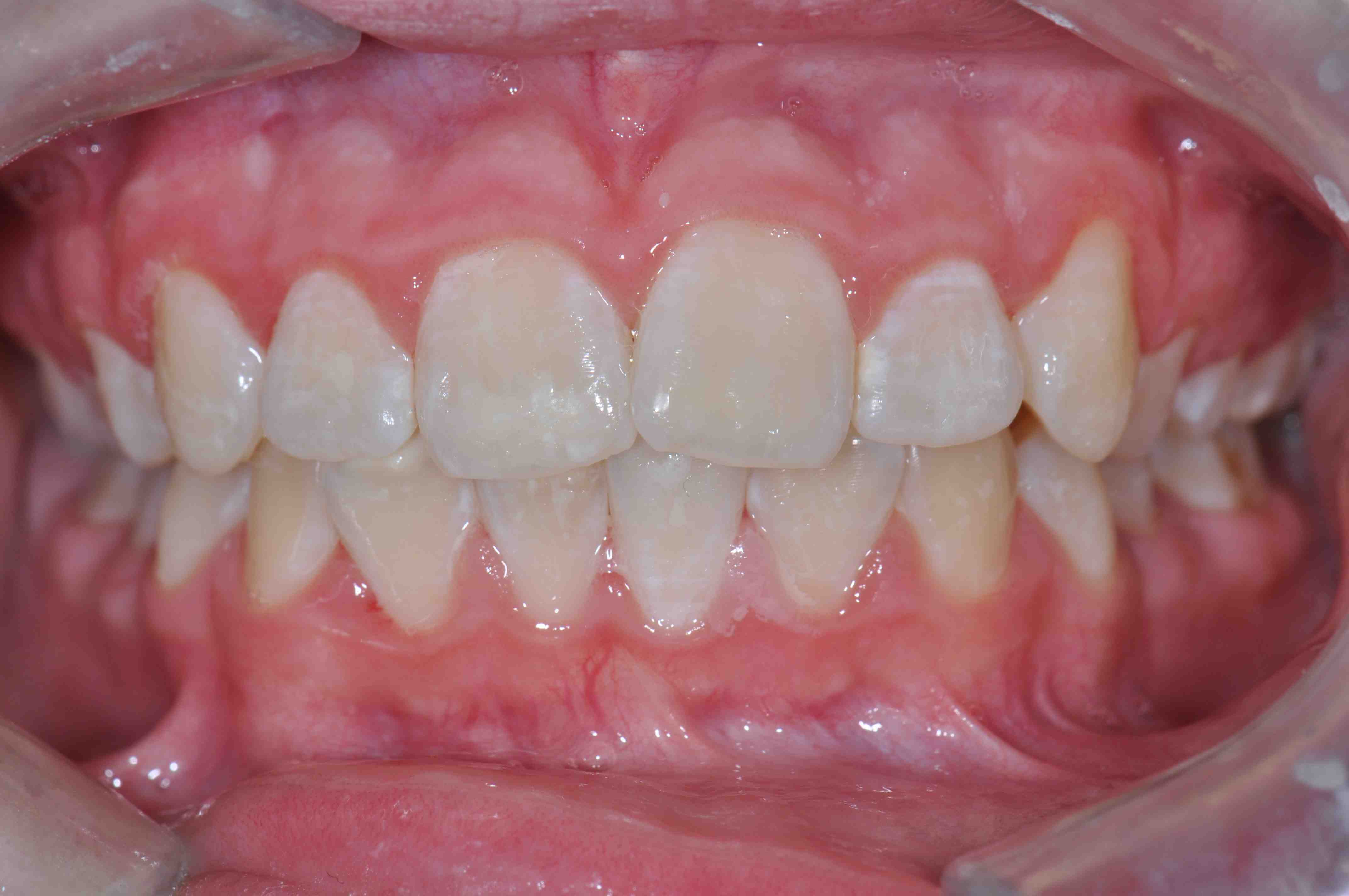 Overnight teeth whitening